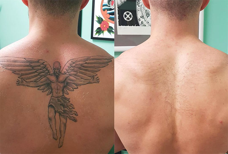 Tattoo Removal Cream
