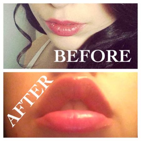 Before And After Photos Of My Lips With Fullips Lip Enhancer
