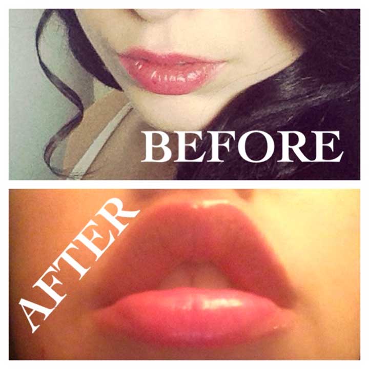 Before And After Photos Of My Lips With Fullips Lip Enhancer