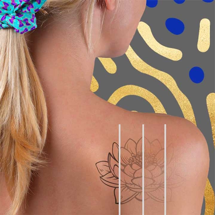Reasons To Get Your Tattoo Removed