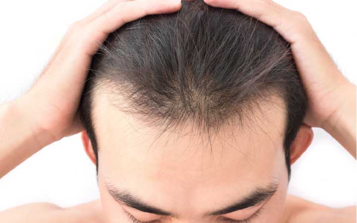 The Primary Causes of Hair Loss