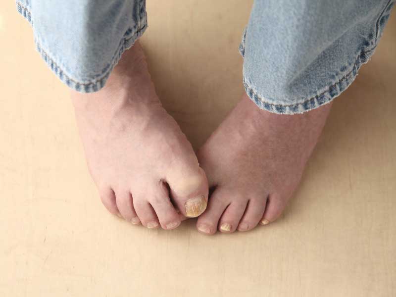 Is it Possible to Treat Fungus in the Toes with Light Therapy?