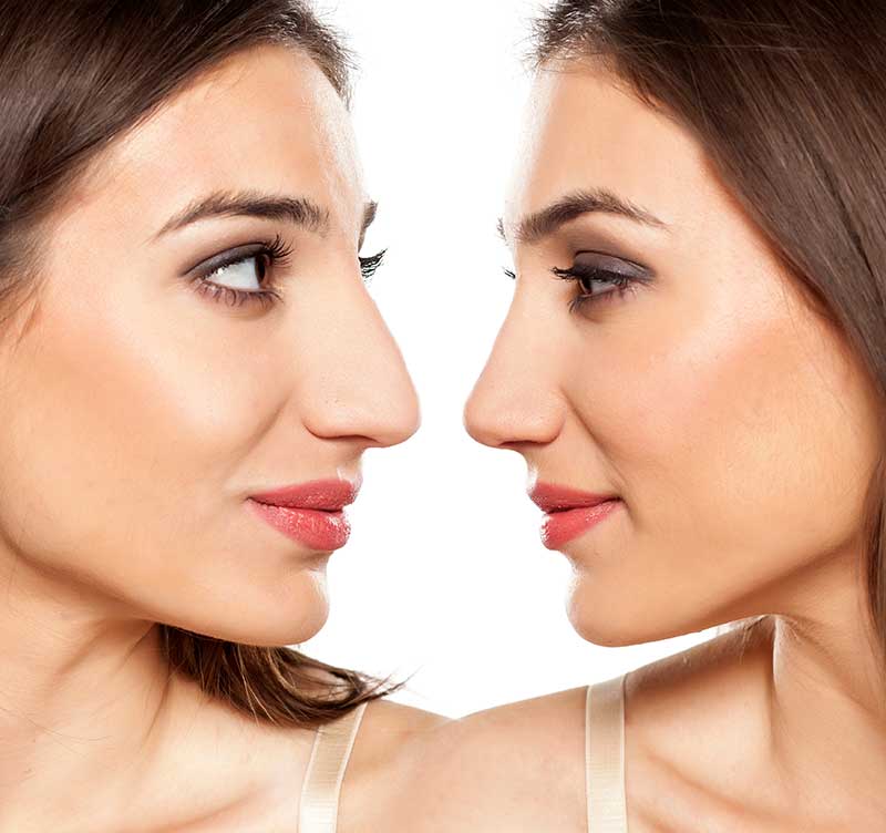 How To Prepare Yourself For A Nose Job