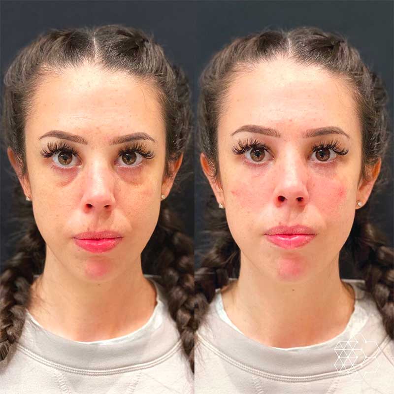 20 Hacks For Fixing Your Under Eye Circles