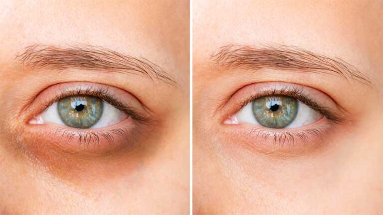 Puffy Under Eye and Dark Circles No More