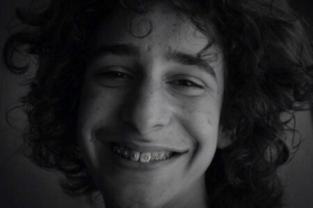 Things to Consider Before Getting Braces