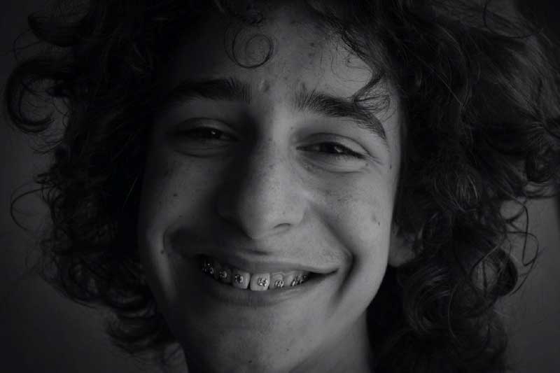 Things to Consider Before Getting Braces
