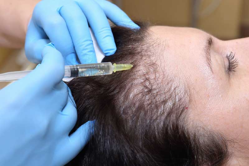 Preparing for Hair Transplant Surgery