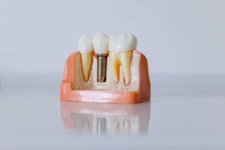 Dental Implants from Start to Finish - What to Expect, How to Recover