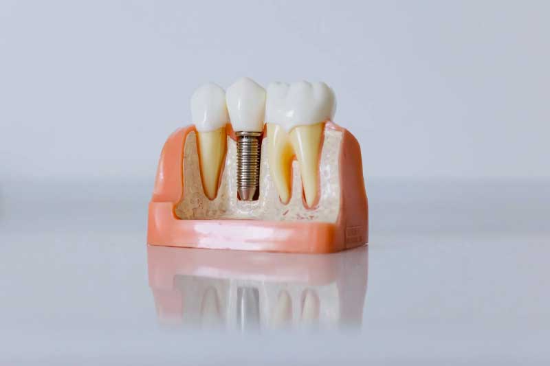 Dental Implants from Start to Finish - What to Expect, How to Recover
