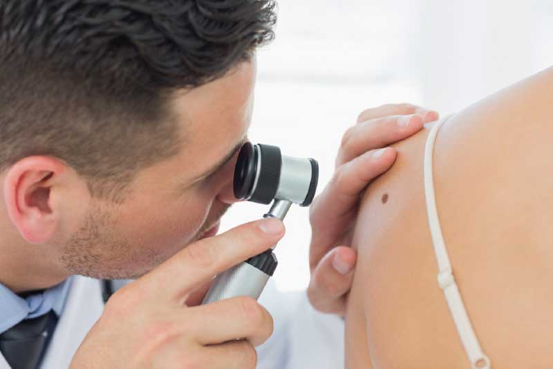 Non-Cancerous Moles: What to Know About the Removal Process