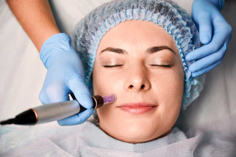 What To Expect In A Microneedling Procedure