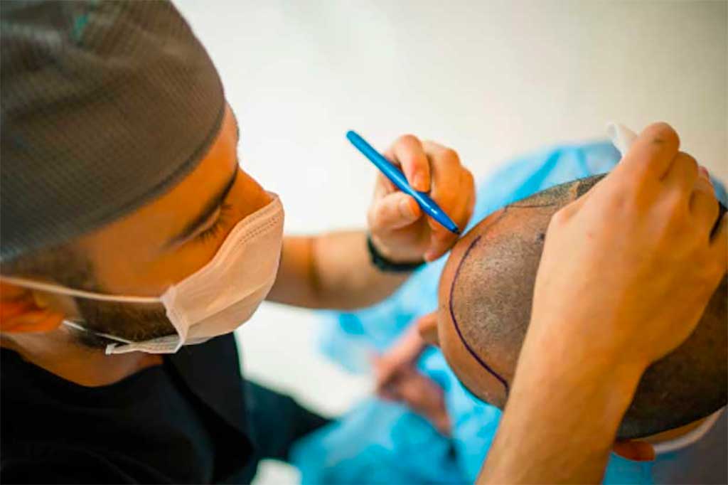 Definition of FUE Hair Transplant