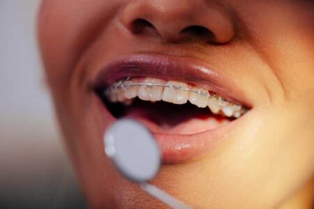 The Best Age Range for Getting Braces for Children