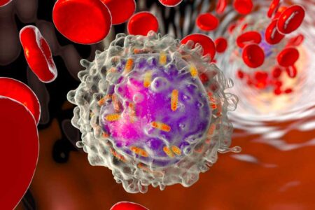 Acute Lymphocytic Leukemia