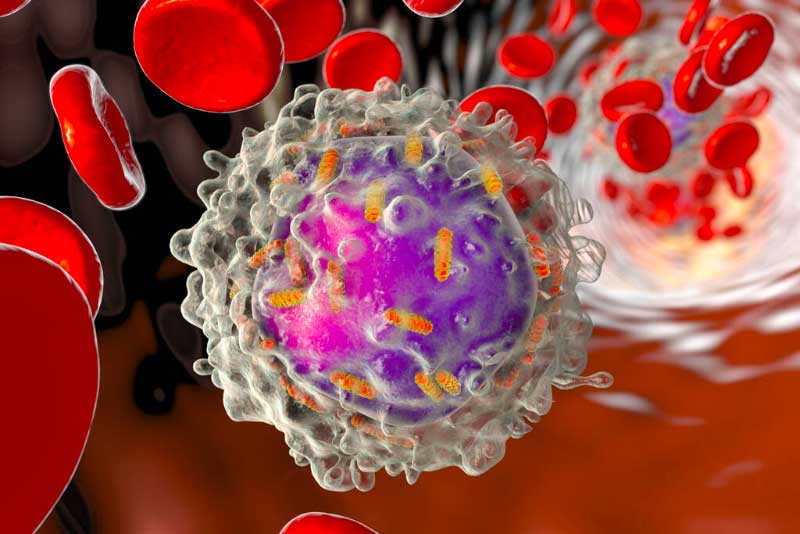 Acute Lymphocytic Leukemia