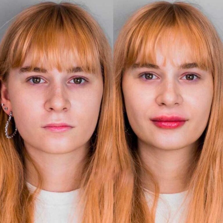Top 5 Benefits of Dermal Fillers with Hyaluronic Acid