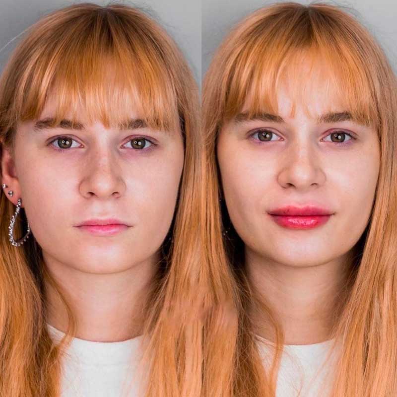 Top 5 Benefits of Dermal Fillers with Hyaluronic Acid