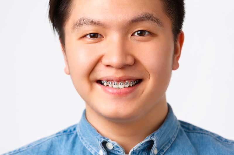 Adult Orthodontic Treatment for a Perfect Smile