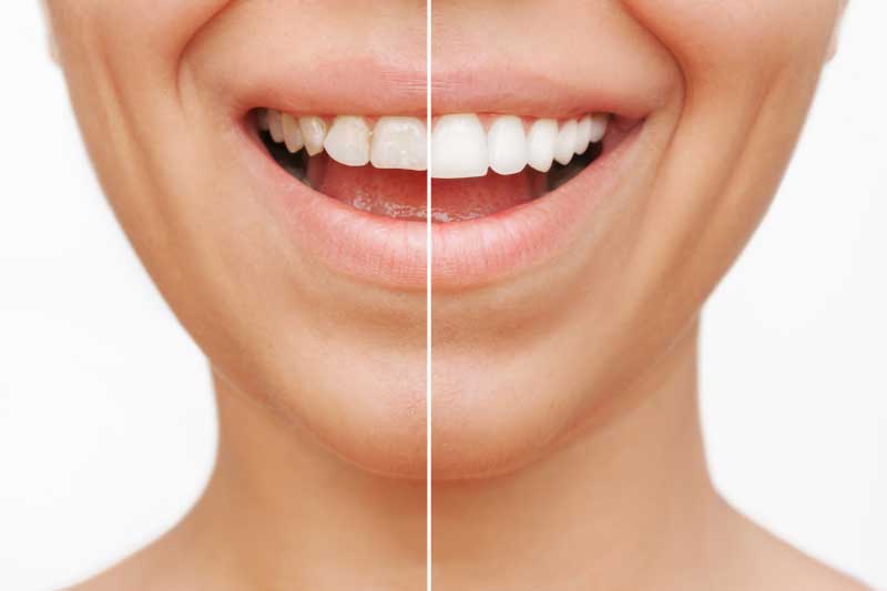 How To Choose The Best Cosmetic Dental Treatment
