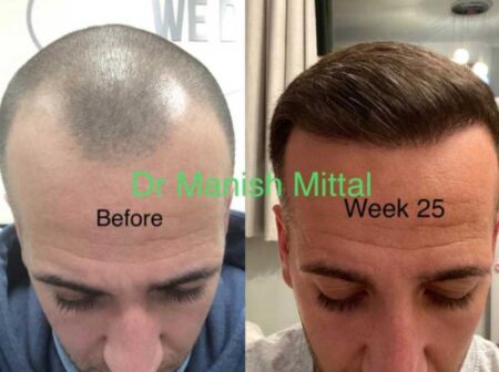 A Comprehensive Guide to Hair Transplant Before and After