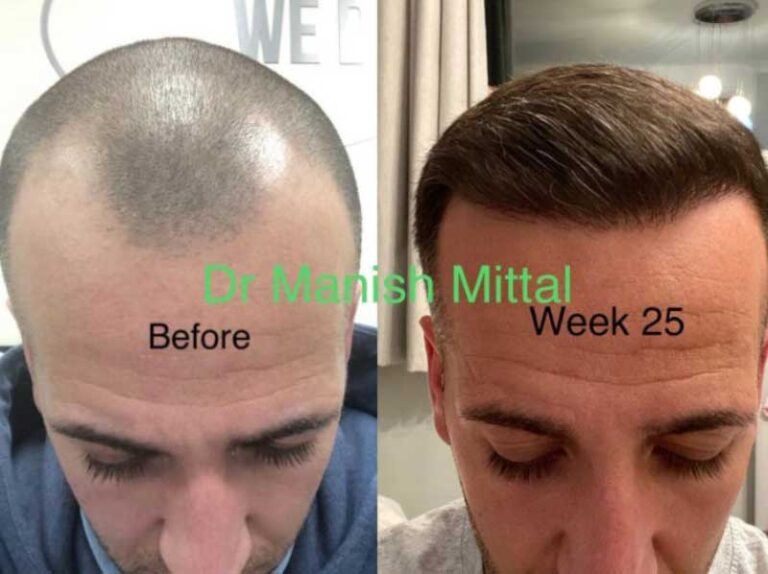 A Comprehensive Guide to Hair Transplant Before and After