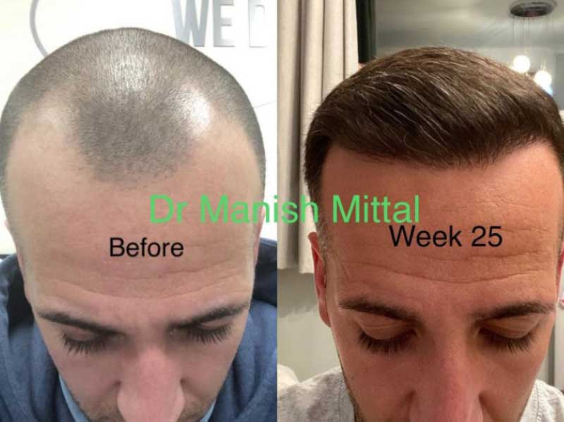A Comprehensive Guide to Hair Transplant Before and After