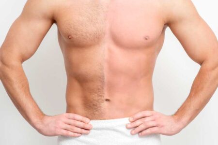 Laser Hair Removal Options for Men