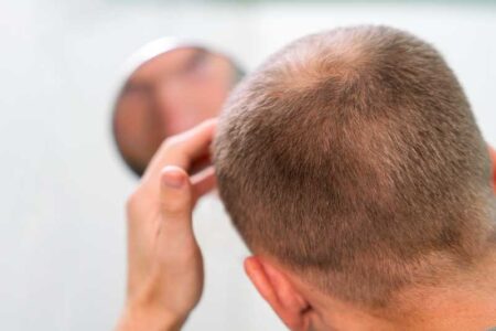 Men and Hair Loss Should You Use A Hair Replacement