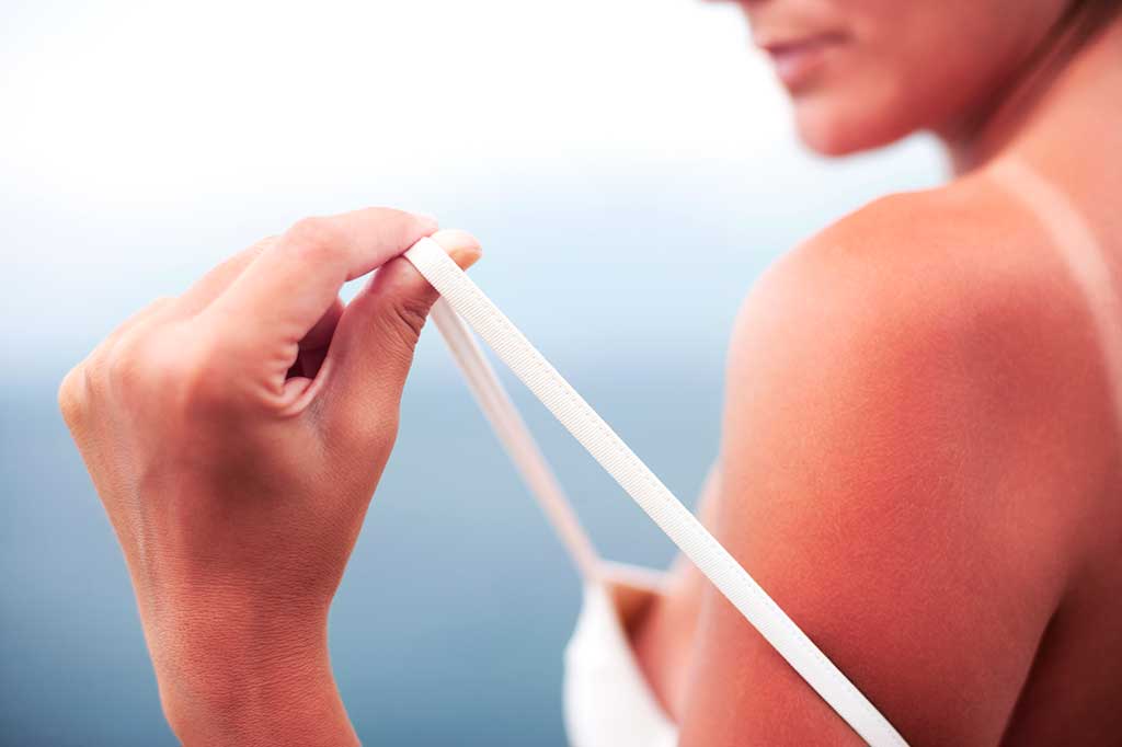 sun burned skin