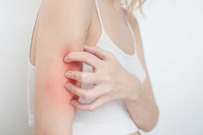 What Are Those Bumps on My Arms? A Rough Guide to KP