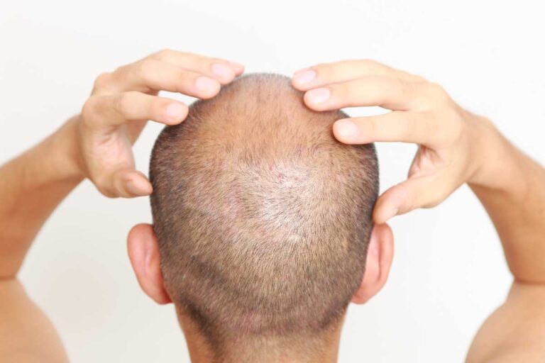 What Is Hair Loss And How Can Hair Filler Miami Help With It