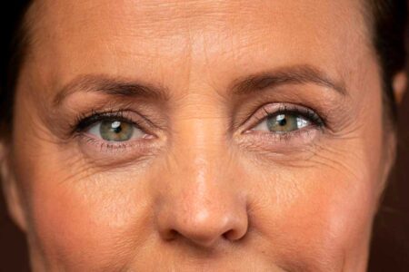 Smooth Away Wrinkles with Dysport in Vancouver