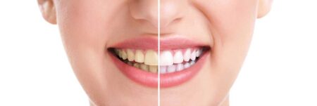 Exploring the Versatile Uses of Teeth Whitening Kits