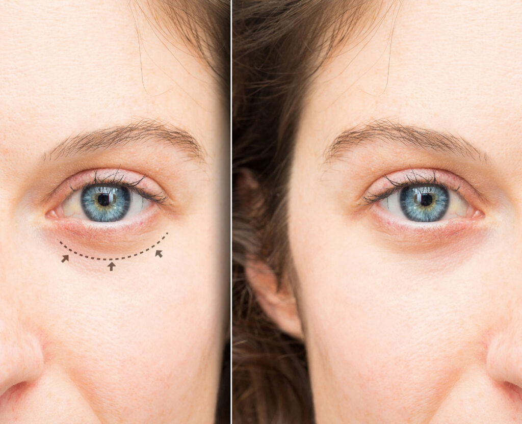 Choosing the Right Eyelid Surgery Clinic: Key Considerations