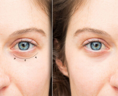 Choosing the Right Eyelid Surgery Clinic: Key Considerations