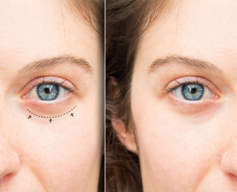 Choosing the Right Eyelid Surgery Clinic: Key Considerations