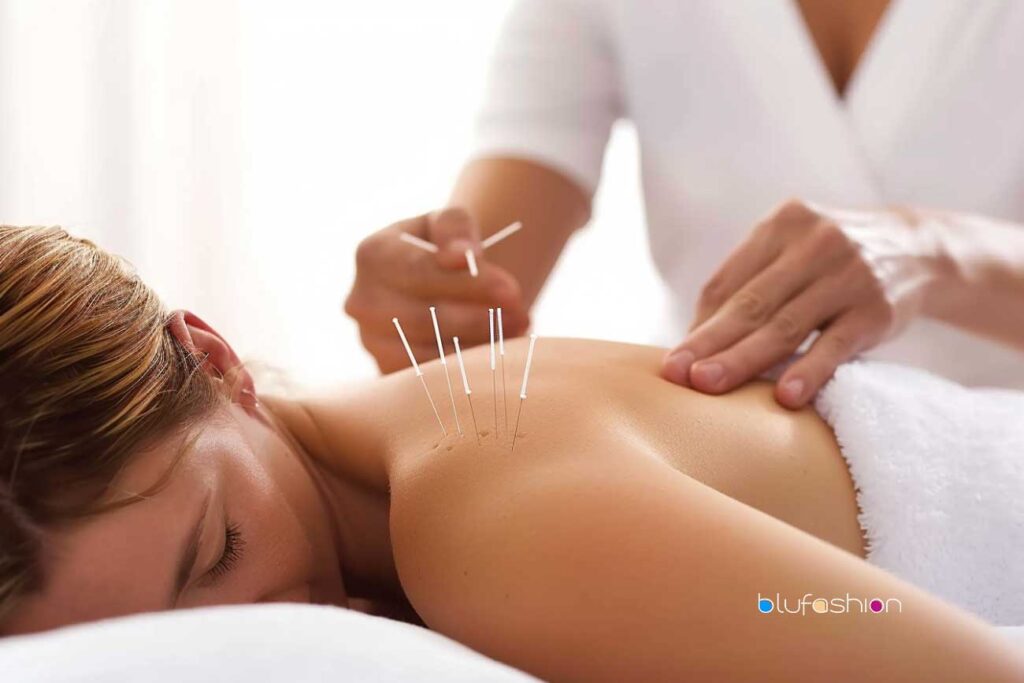 I Tried It & Here’s the Top 10 Benefits of Acupuncture