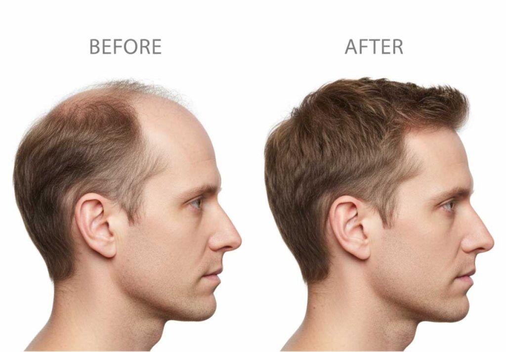Most Effective Hair Loss Treatments for Men